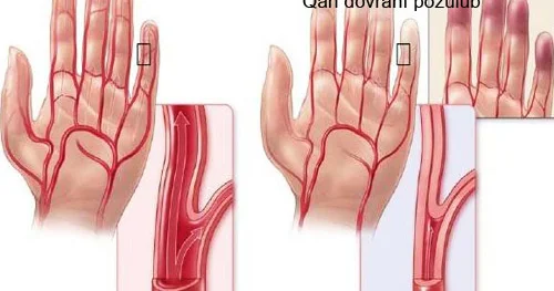 Siqaret çəkənlər mütləq oxusun! Bürqer xəstəliyi