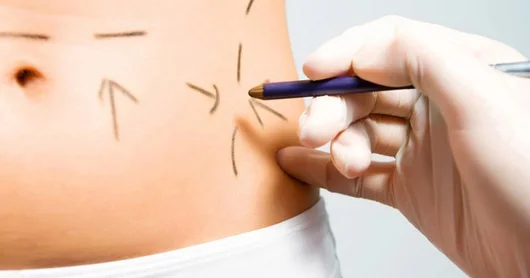 Liposaksiyanın TƏHLÜKƏLƏRİ. Gözəllik qurban tələb edirmi?