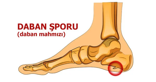 Daban mahmızına 7 TƏBİİ ÇARƏ