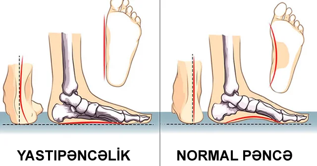 Yastıpəncəliyin simptomları və müalicəsi