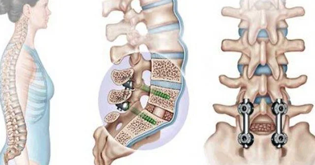 Onurğa implantı əməliyyatı nədir və nə zaman tətbiq olunur?