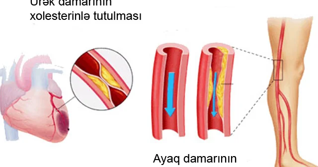 Damarları təmizləyən TƏBİİ VASİTƏLƏR. 7 faydalı resept
