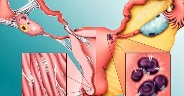 Ağrılı menstruasiyaların əsas səbəbi BU XƏSTƏLİKDİR