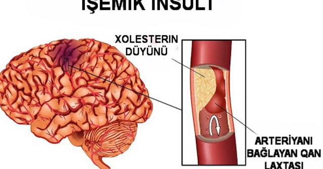 30 yaşdan sonra insultdan qorunmaq üçün nə etməli 7 MƏSLƏHƏT