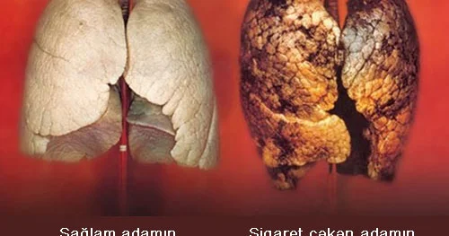 Siqaretdən bu gün imtina edin! FOTO