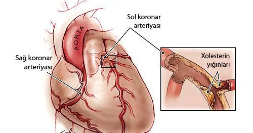 Ürəyin işemik xəstəliyi (ÜİX)