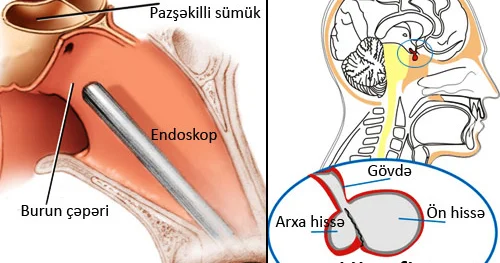 Prolaktinoma hormonal pozulmaların səbəbi