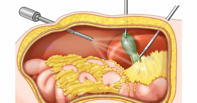 Öd daşı xəstəliyinin CƏRRAHİ MÜALİCƏSİ