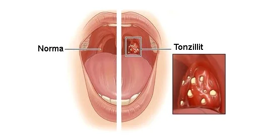 Anginanın xalq təbabəti üsulları ilə müalicəsi