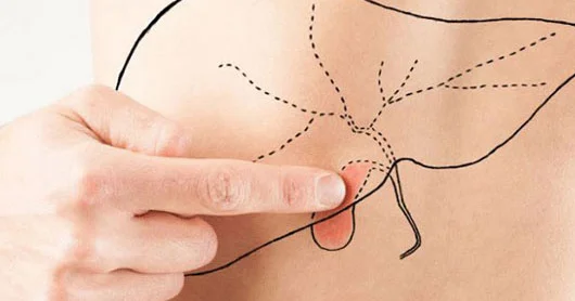 Öd kisəsində polip: əməliyyat mütləqdir?