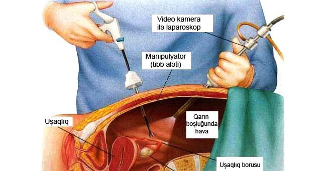 Yumurtalığın həqiqi kistaları