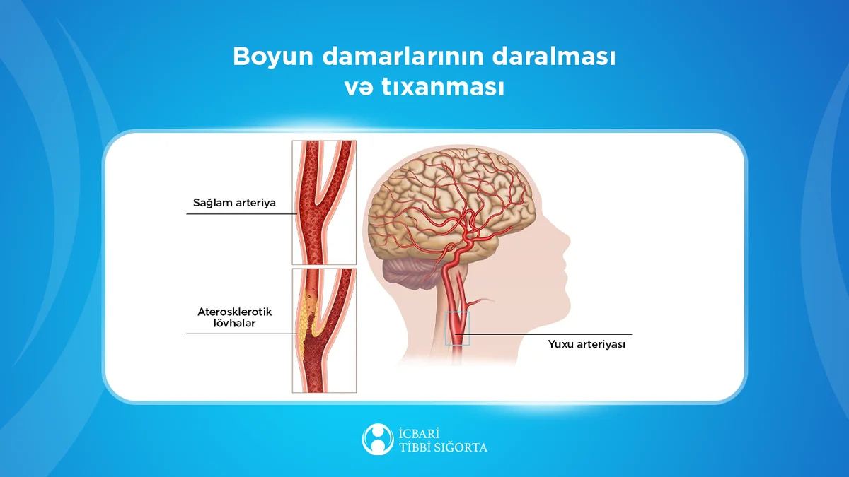 Beyin qan dövranı pozulmalarının diaqnostika və müalicəsi icbari tibbi sığorta təminatına daxildir