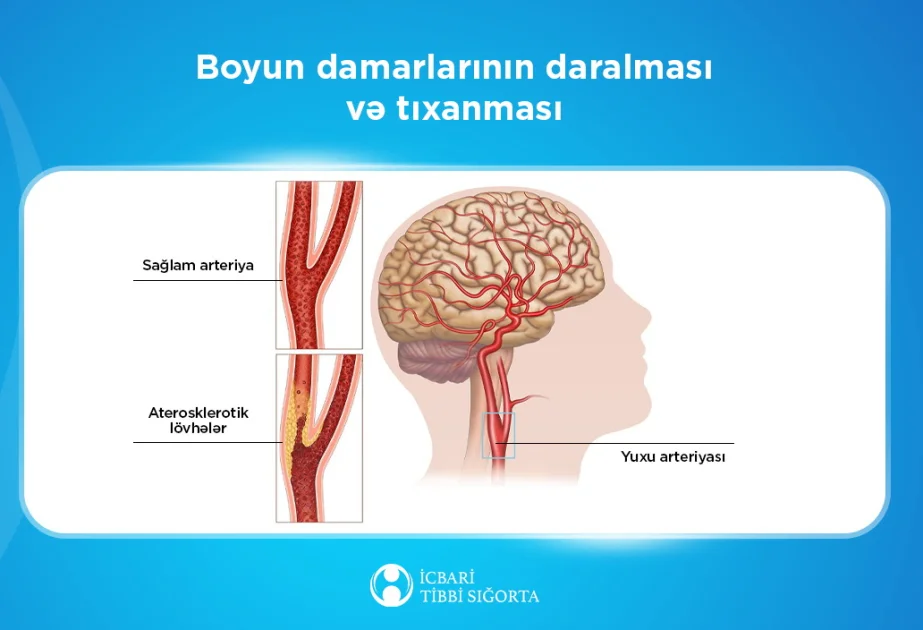 Agentlik: Beyin qan dövranı pozulmalarının müayinə və müalicəsi icbari tibbi sığorta təminatına daxildir AZƏRTAC