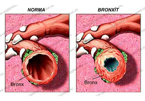 Bronxit. Risk faktorları və əlamətlər