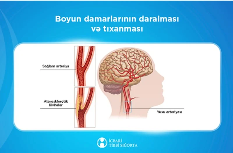 Bu müalicə də icbari tibbi sığortaya daxildir