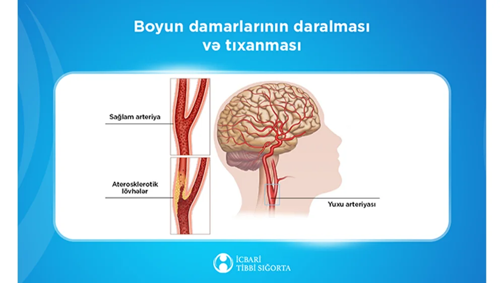 Bu müalicə də icbari tibbi sığortaya daxildir KONKRET