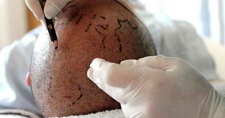 Приехавший в Стамбул британец умер после пересадки волос и стоматологического лечения