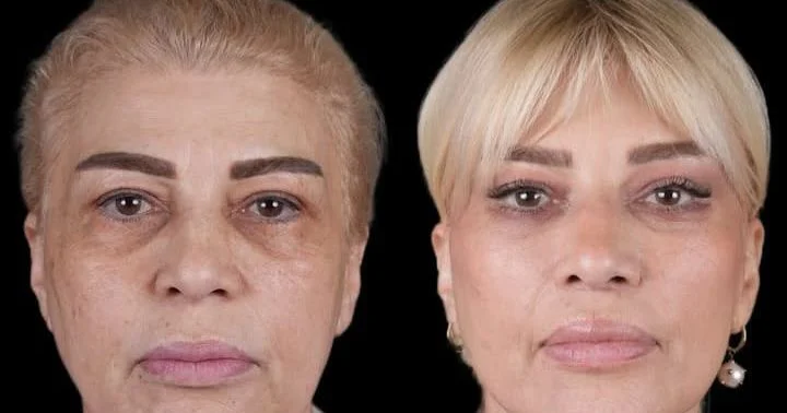 Mətanət İsgəndərlinin dəyişimi gündəm oldu FOTO