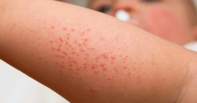 Uşaqlar arasında yayılan bu xəstəlik ürəyi və böyrəyi zədələyə bilər XƏBƏRDARLIQ