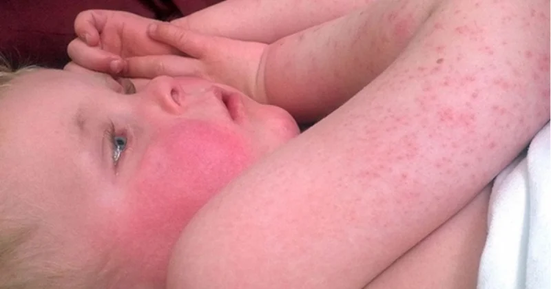 SOS! Bağça və məktəblərdə bu virus yayılıb…