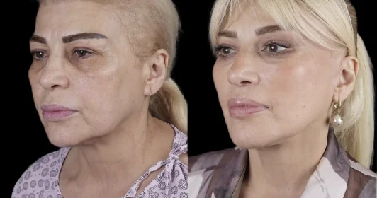 Əməkdar artist əməliyyatla tanınmaz hala düşdü FOTO