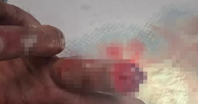 Barmağı qopan şəxs onu buzda saxlayaraq Türkiyəyə çatdırdı