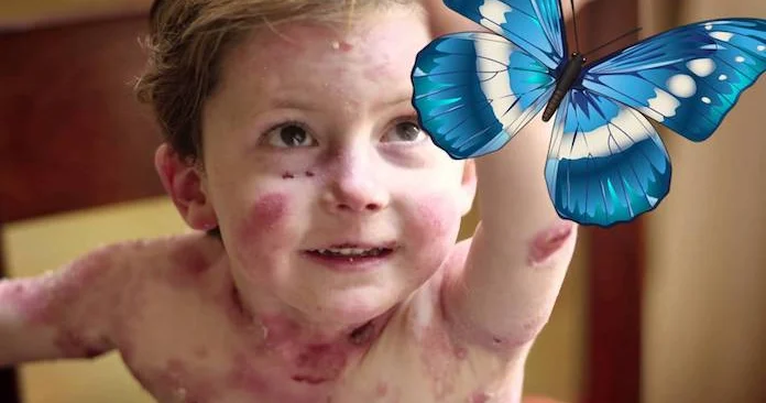 Kəpənək xəstəliyi ilə mübarizəyə 1,3 milyon vəsait ayrıldı