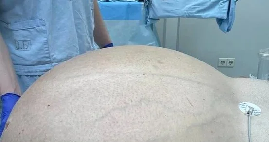 Rusiyada həkimlər kişidən 60 kiloqramlıq şiş çıxarıblar