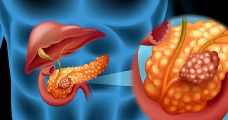 Mədəaltı vəzinin xərçənginin inkişafını ləngidən gen aşkarlandı