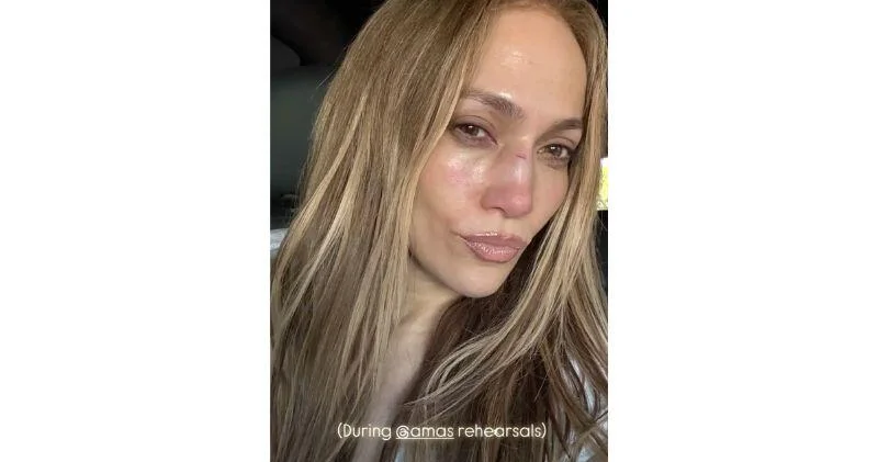Дженнифер Лопес показала травму на лице