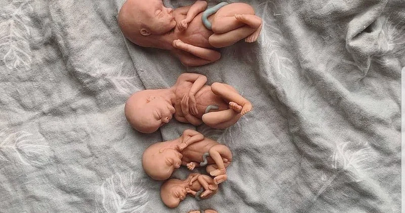 Abortlar problemi təkcə qanunla həllini tapa bilməz Həkim ginekoloq