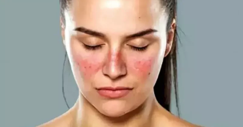 Üzdəki ləkələr lupus əlaməti OLA BİLƏR
