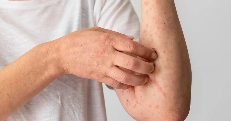Alimlər hər il 11 milyon insanı öldürən infeksiyanı dayandıra bilən anticisim yaradıblar