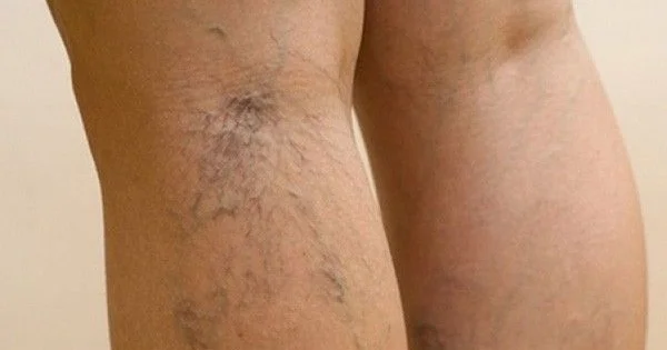 Varikoz damarlarını artıran içki Hamı içir