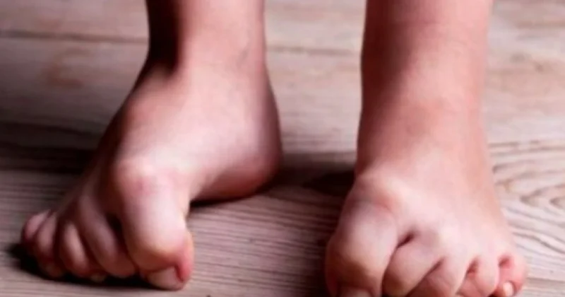 Narahat ayaqlar sindromu parkinson xəstəliyi riskini artıra bilər TƏDQİQAT