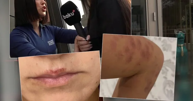 Bakıda salonda qadını lazer edərkən yandırdılar İDDİA