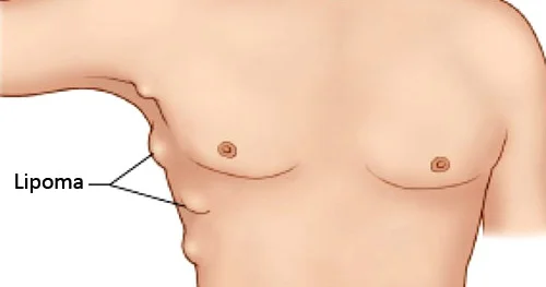 Lipoma piy şişi