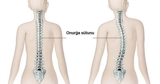 Skoliozu aşkarlamanın 8 YOLU