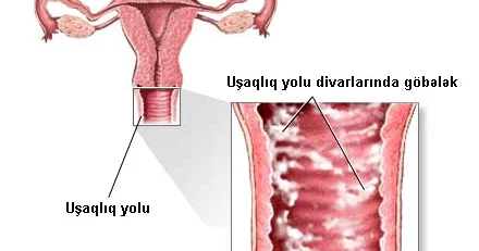 Qadınlarda göbələk xəstəliyi