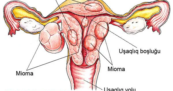 Uşaqlığın mioması Azərbaycanda çox yayılmış xəstəlikdir