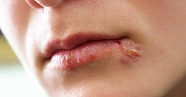 Herpes virusu və onunla mübarizə yolları