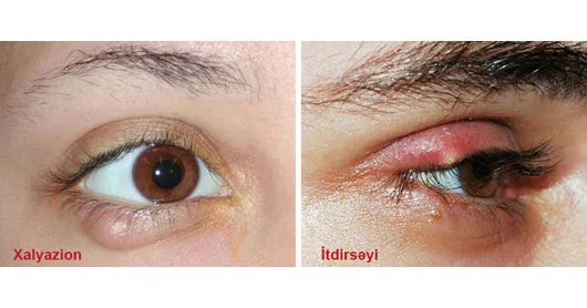 İtdirsəyi və xalyazion. Necə müalicə edilir?