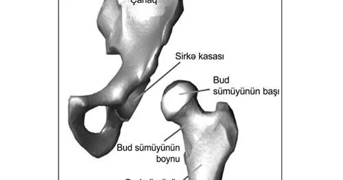 Bud çanaq oynağının displaziyası, budun anadangəlmə yarımçıxığı və tam çıxığı