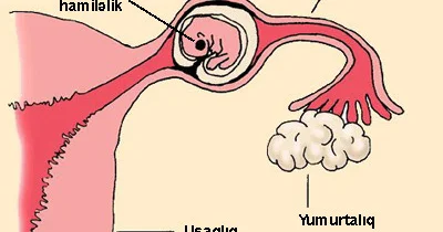 Uşaqlıqdan kənar hamiləklə bağlı olan bəzi yalnış fikirlər