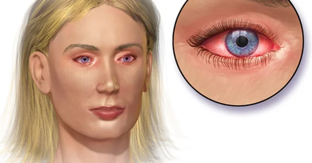 Gözdə qaşınma, sulanma nəyin əlamətidir? HƏKİM XƏBƏRDARLIĞI