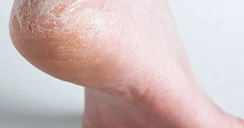 Daban çatları sizi tez tez narahat edirsə, şəkərinizi yoxlayın