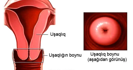 Uşaqlıq boynu eroziyası