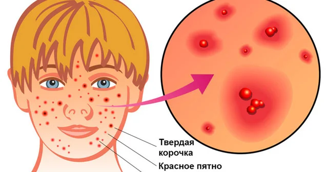 Suçiçəyi xəstəliyi niyə böyüklər üçün təhlükəlidir?