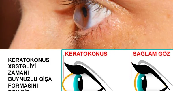 Keratokonus ağır göz xəstəliyi
