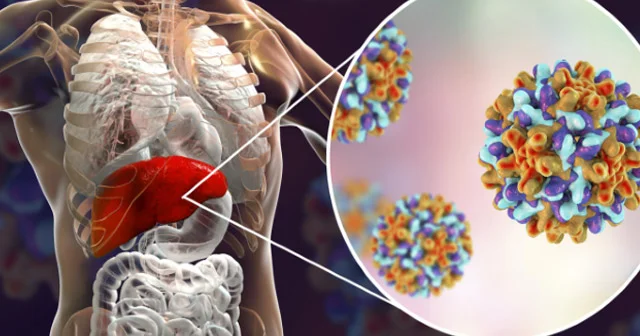 Ağır qaraciyər xəstəliklərinin əsas səbəbi Hepatit C, B və D virusları